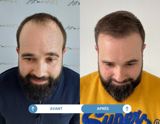 Greffe de cheveux de David avant / après