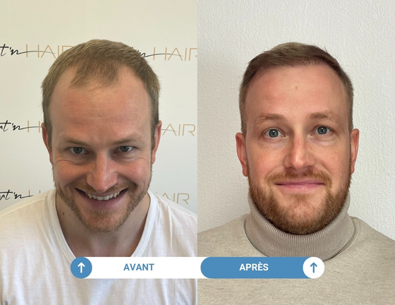 Etude de cas greffe de cheveux Fabian avant / après