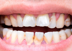 dents abimees avec caries