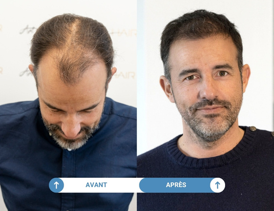Étude de cas greffe de cheveux Cédric avant / après