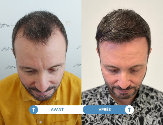 Greffe de cheveux Jérôme avant / après