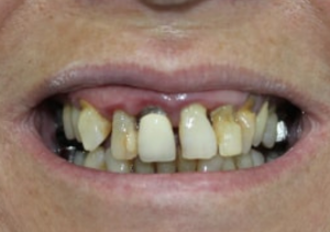 dents qui se déchaussent et tombent