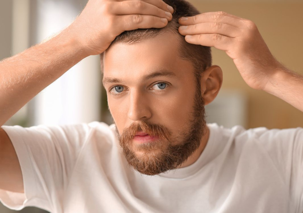 homme début de calvitie