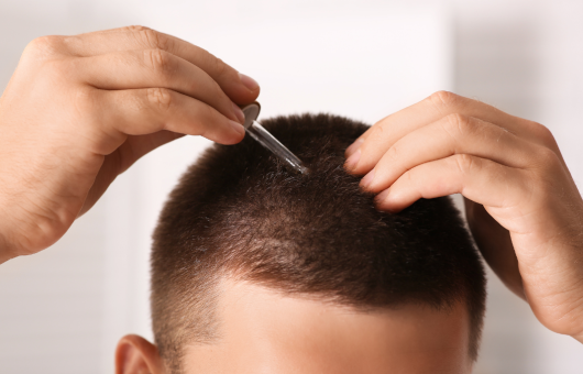 Application du minoxidil 5