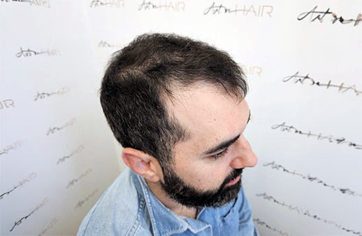 Nicolas Fregefond avant greffe de cheveux