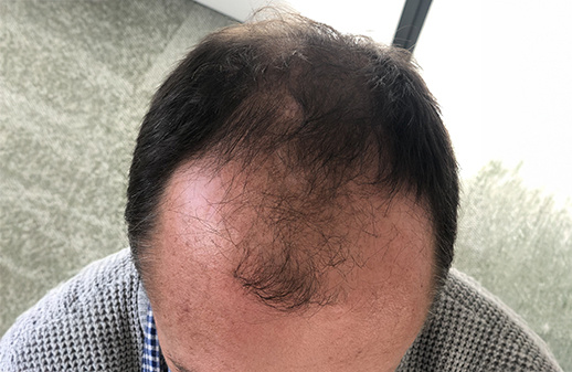 Nicolas Plessis avant la greffe de cheveux