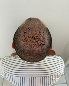 Tony 10 jours après sa greffe de cheveux