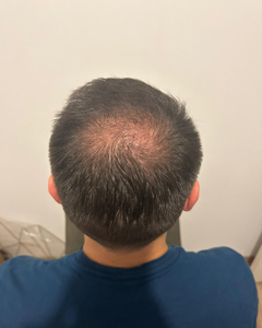 Tony 3 mois après sa greffe de cheveux