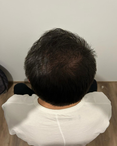 Tony 6 mois après sa greffe de cheveux