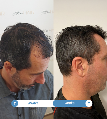 Etude de cas avant / après la greffe de cheveux de Martin