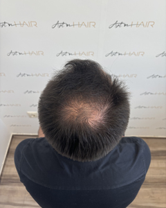 Tony avant sa greffe de cheveux