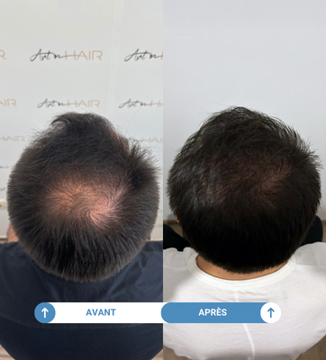 Etude de cas de Tony ayant réalisé une greffe de cheveux avec Smile Partner