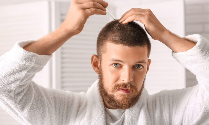 homme qui a fait une greffe de cheveux