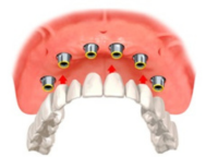 illustration prothèse dentaire sur 6 implants