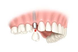 couronne sur implant dentaire
