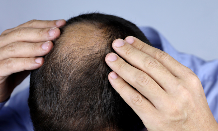 homme avec un dégarnissement des cheveux à la tonsure
