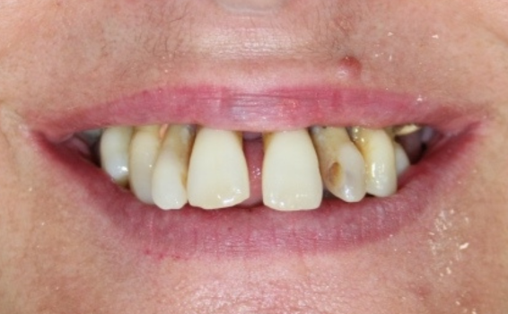 sourire avant soins dentaires maube