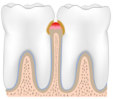 gingivite illustration