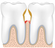 dechaussement dentaire illustration