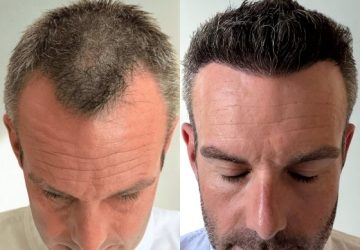 julien avant et apres greffe de cheveux
