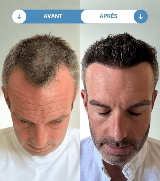 julien avant et apres greffe de cheveux