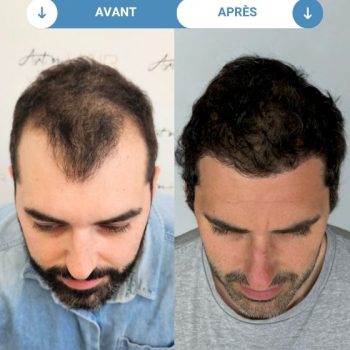 nicolas avant et apres greffe de cheveux