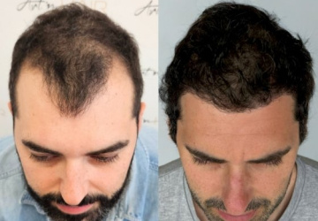 nicolas avant et apres greffe de cheveux