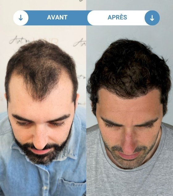 nicolas avant et apres greffe de cheveux