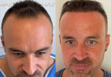 julien avant et apres greffe de cheveux