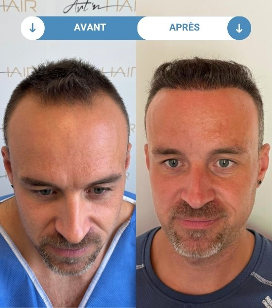 julien avant et apres greffe de cheveux