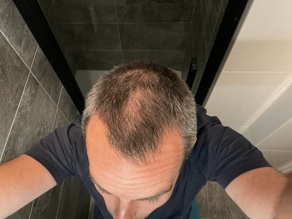calvitie julien avant sa greffe de cheveux