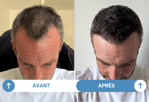 julien avant et apres greffe de cheveux