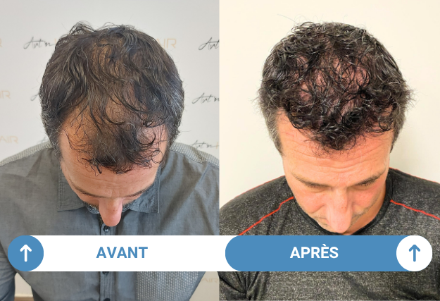 illustration avant apres greffe de cheveux martin
