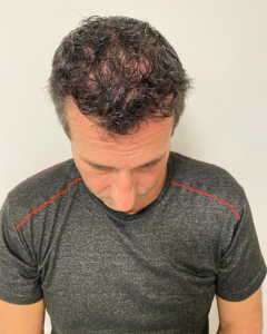 greffe de cheveux patient apres 1 an