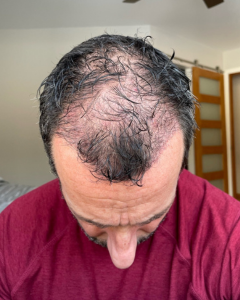 apres 3 mois post greffe de cheveux