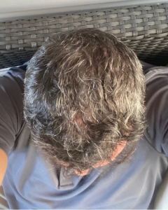 9 mois post greffe de cheveux