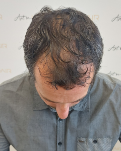 greffe de cheveux patient avant