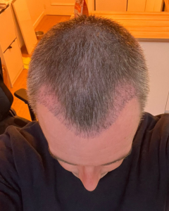 Julien 1 mois après sa greffe de cheveux