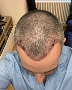 Julien 15 jours après sa greffe de cheveux