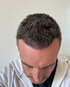Julien 6 mois après sa greffe de cheveux