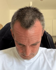 avant greffe de cheveux temoignage patient