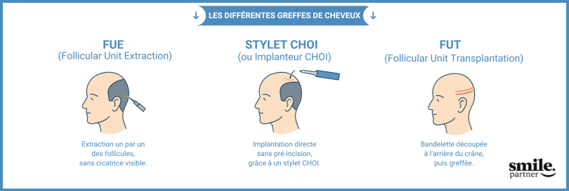 illustration des différentes méthodes de greffe de cheveux