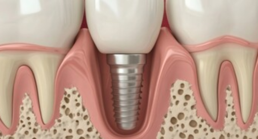 illustration de la cicatrisation osseuse d'un implant