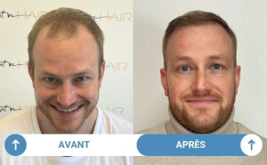 avant après fabian