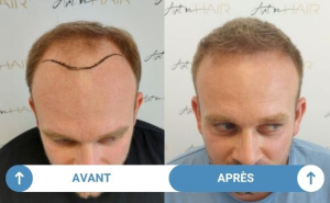 avant après victor