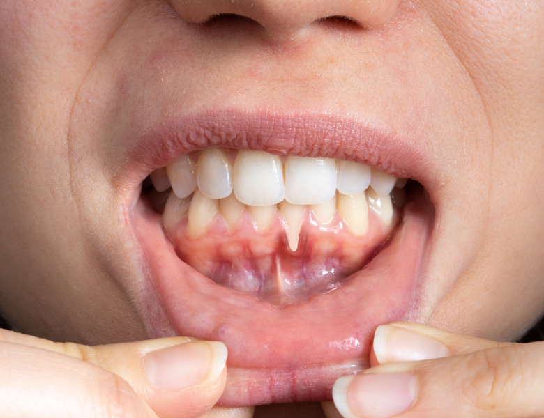 dents qui se déchaussent