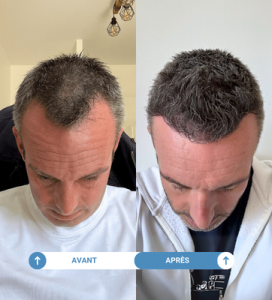 Etude de cas de Julien ayant réalisé une greffe de cheveux avec Smile Partner