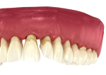 Illustration d'une parodontite avec dents déchaussées