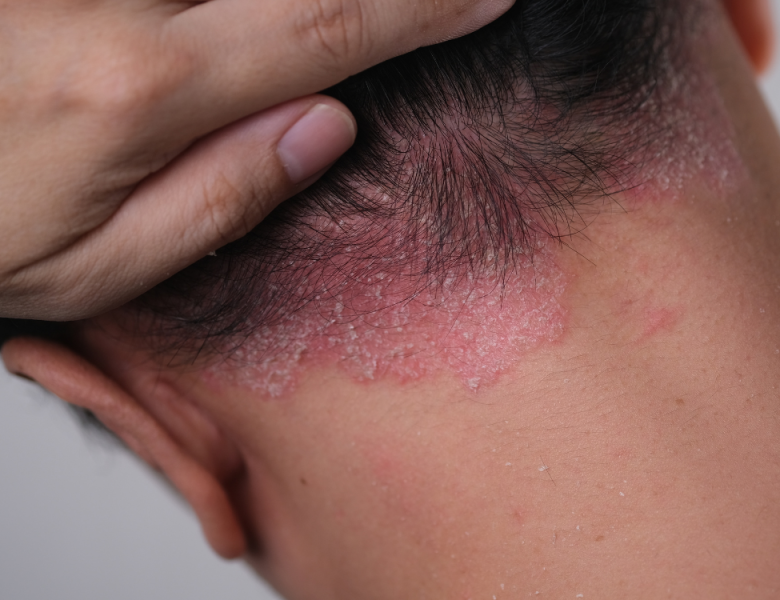homme ayant du psoriasis sur le cuir chevelu