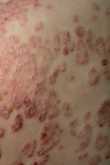 peau avec un psoriasis en gouttes